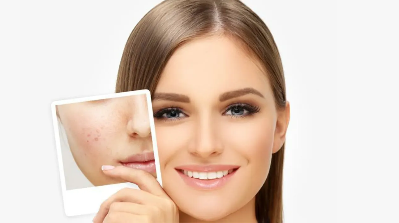 کانسیلر برای محو تیرگی و لک‌های سیاه